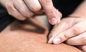 Acupuncture Bloomington MN