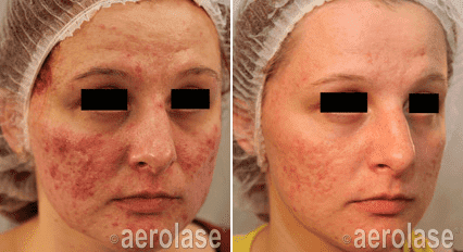 Acne Treatment Results in Bloomington MN